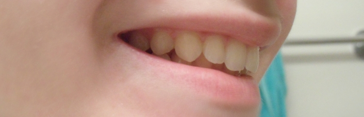 teeth after side